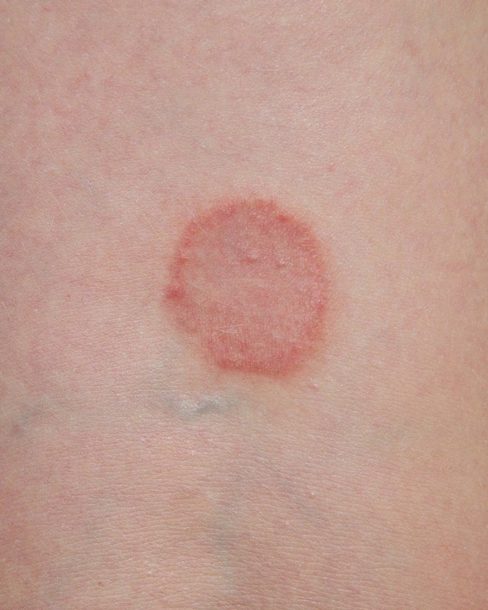 ringworm rash on skin